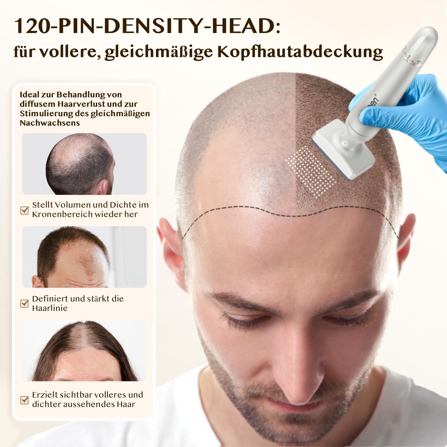BioPen mit 120-Pin-Density-Head. Anwendung auf Kopfhaut. Haarausfall, dichteres Haar. Mann mit Haarausfall.