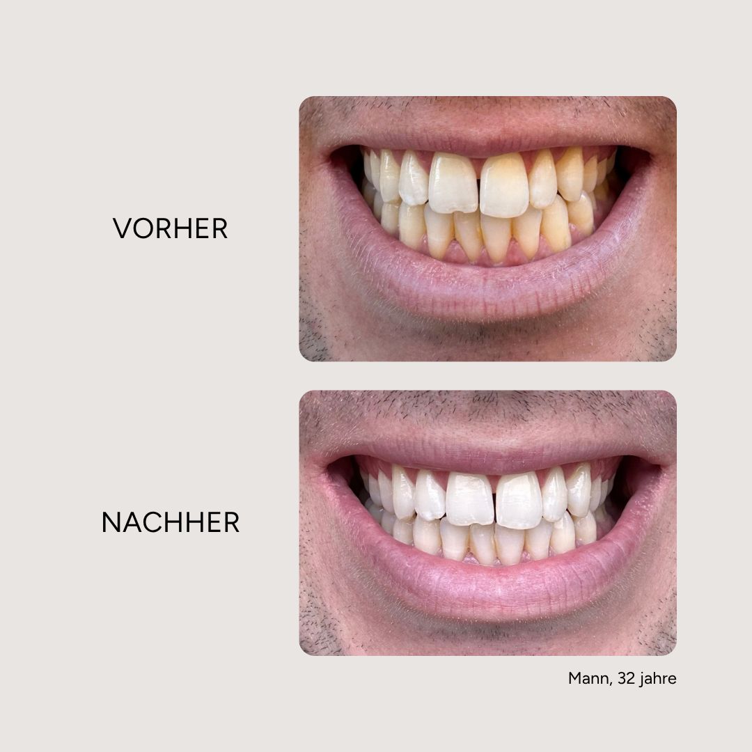 Vorher-Nachher-Vergleich. Zähne vor und nach der Behandlung. Text: Vorher, Nachher. Mann, 32 Jahre.