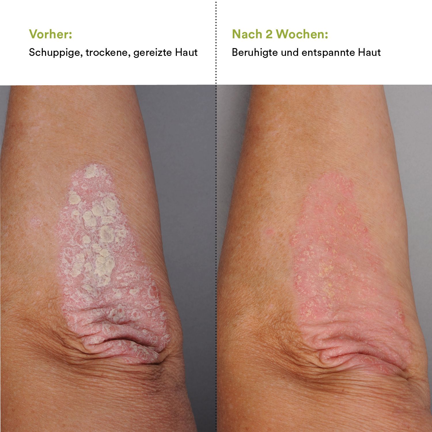 Vorher/Nachher-Vergleich: Schuppige, trockene Haut vs. beruhigte Haut. Gezeigt wird ein Arm.