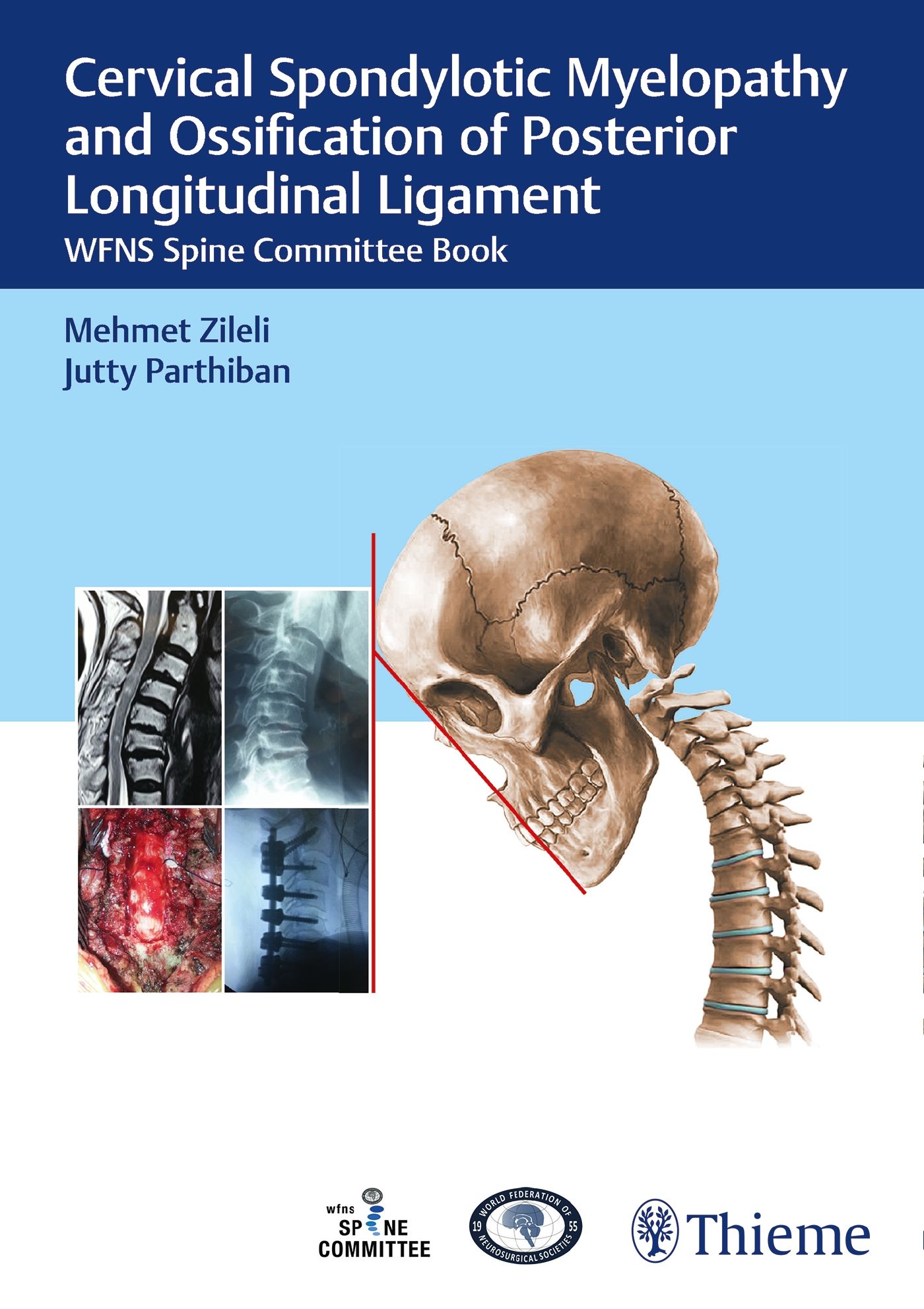 Cervical Spondylotic Myelopathy And Ossification Of Posterior ...