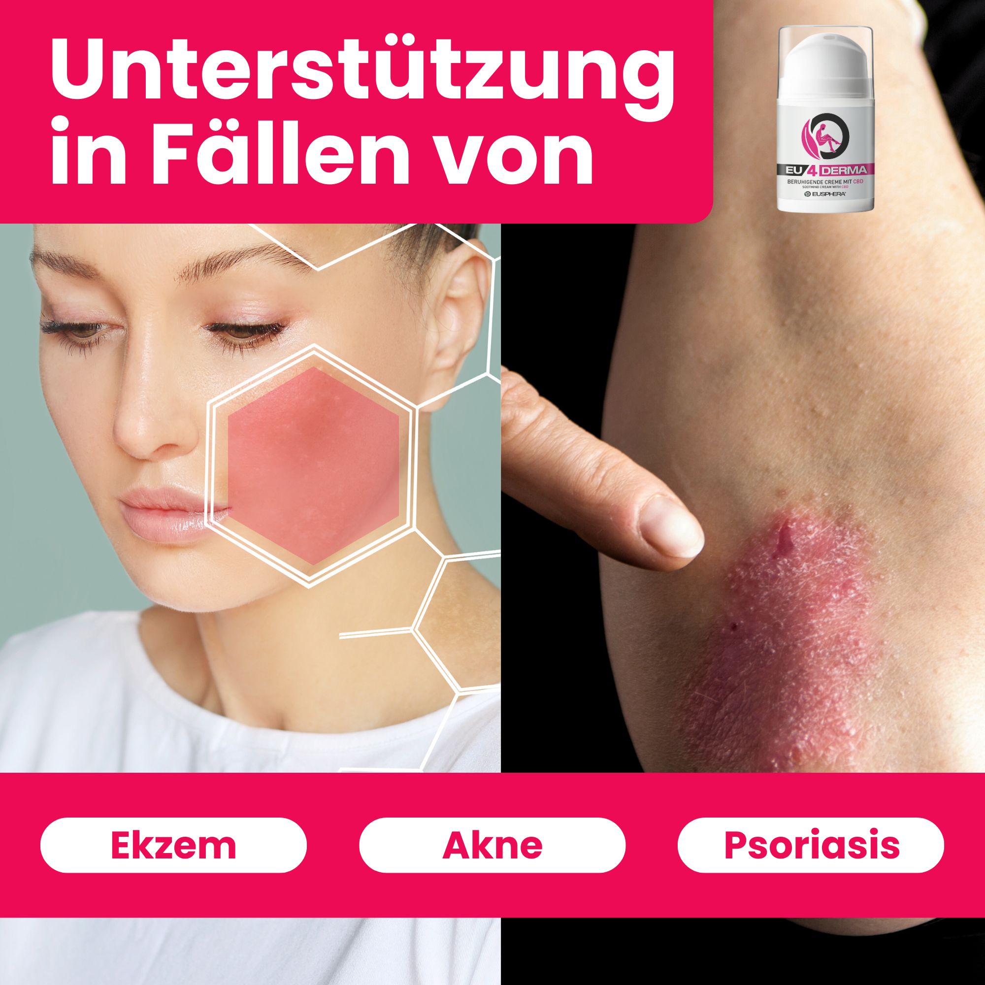 CBD Creme für Akne, Ekzem und Psoriasis | EU4DERMA - Eusphera