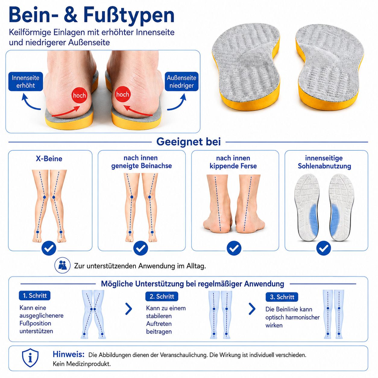 Illustrationen von Bein- und Fußtypen, die die Anwendung von keilförmigen Einlagen erklären.