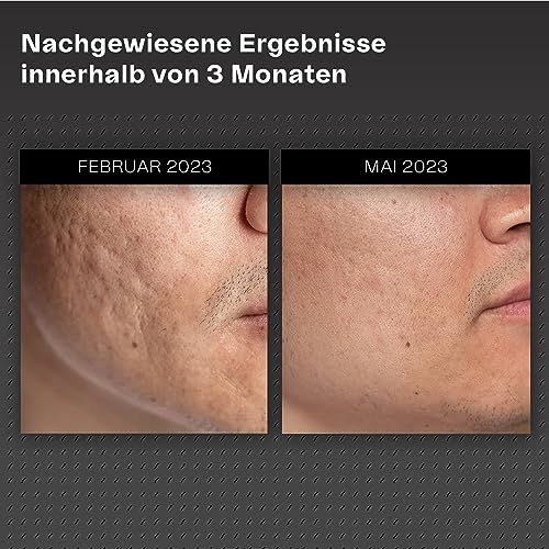Vorher-Nachher-Vergleich. Haut mit Narben. Deutliche Verbesserung nach 3 Monaten.