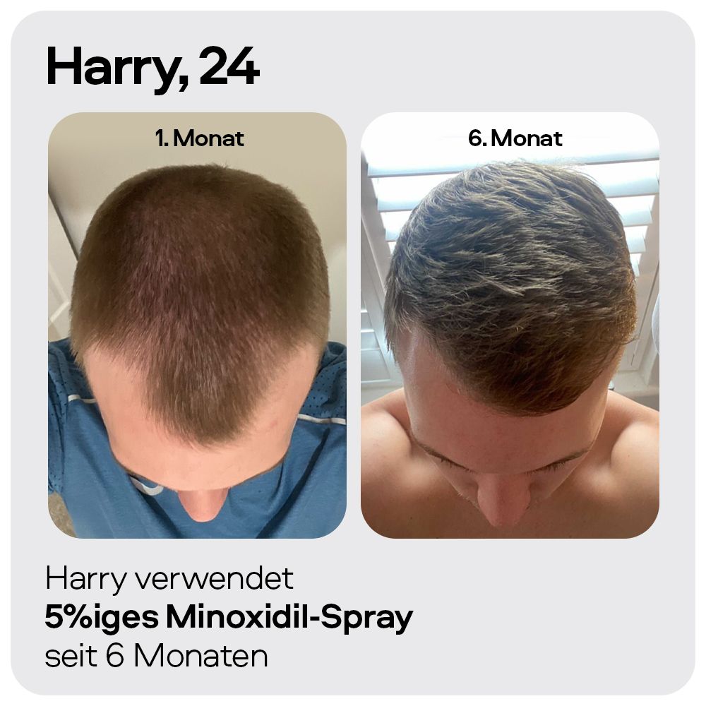 Vorher-Nachher-Vergleich. Zwei Bilder zeigen den Haarwuchs nach 1 und 6 Monaten. Text: Harry verwendet 5%iges Minoxidil-Spray.