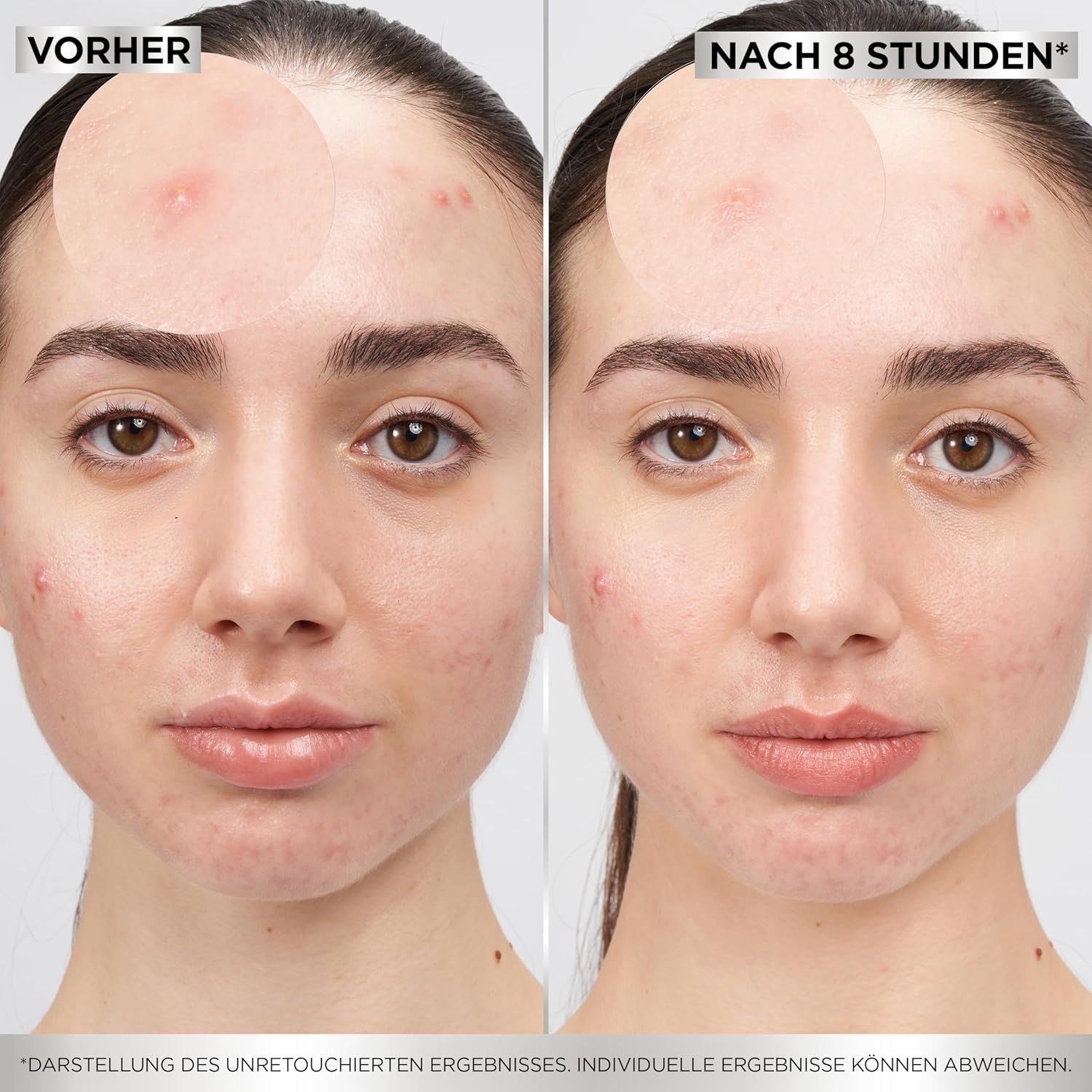 Vorher-Nachher-Vergleich. Zwei Gesichter. Links: Hautunreinheiten. Rechts: Deutlich verbesserte Haut.