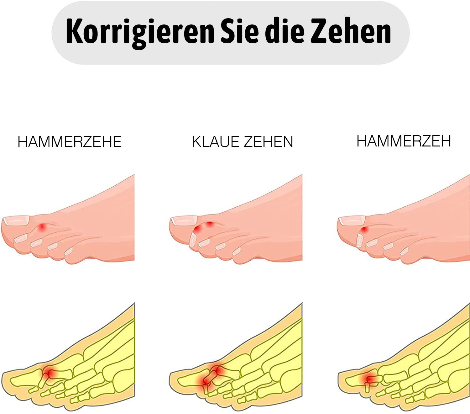 Illustrationen von Fußproblemen: Hammerzehe, Krallenzehen, Hammerzehe. Anatomische Darstellung.