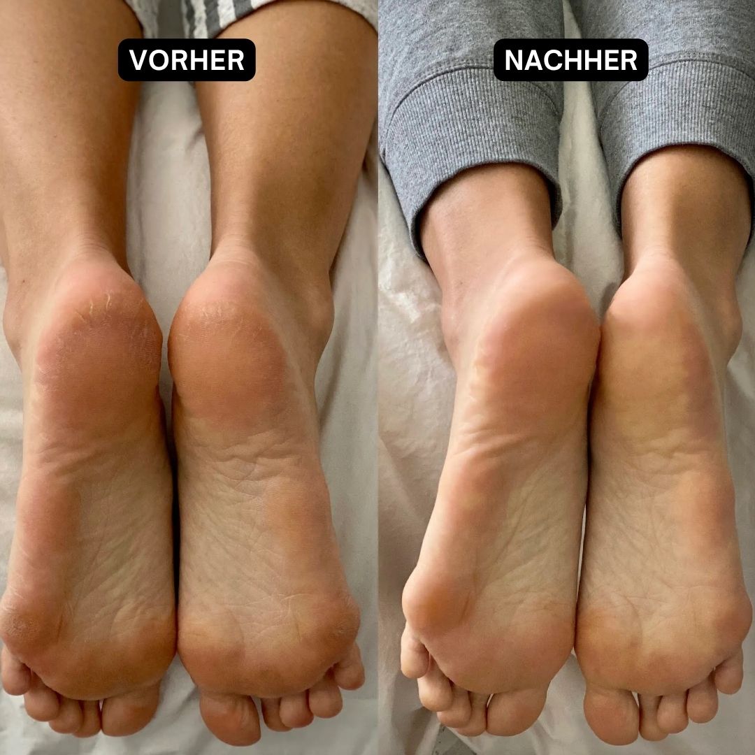Vorher-Nachher-Vergleich von Füßen. Links: rissige Fersen. Rechts: glatte, gepflegte Füße.