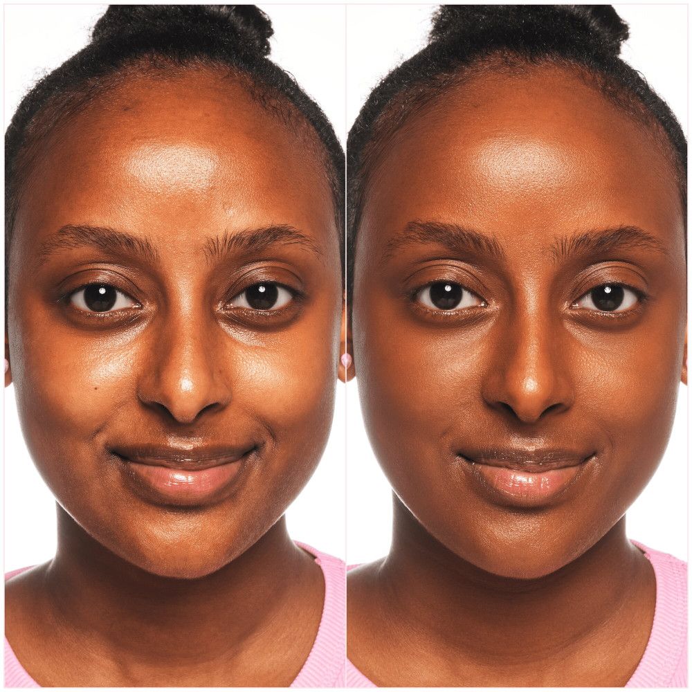 Vorher-Nachher-Vergleich. Zwei Gesichter. Links: Hautunreinheiten. Rechts: ebenmäßiger Teint. Beide Frauen lächeln.