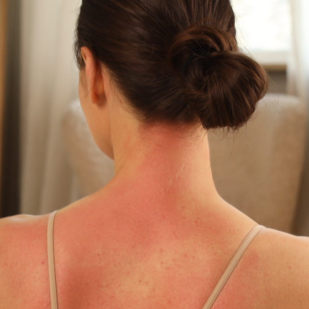 Rötung am Nacken und den Schultern einer Person mit hochgesteckten Haaren.