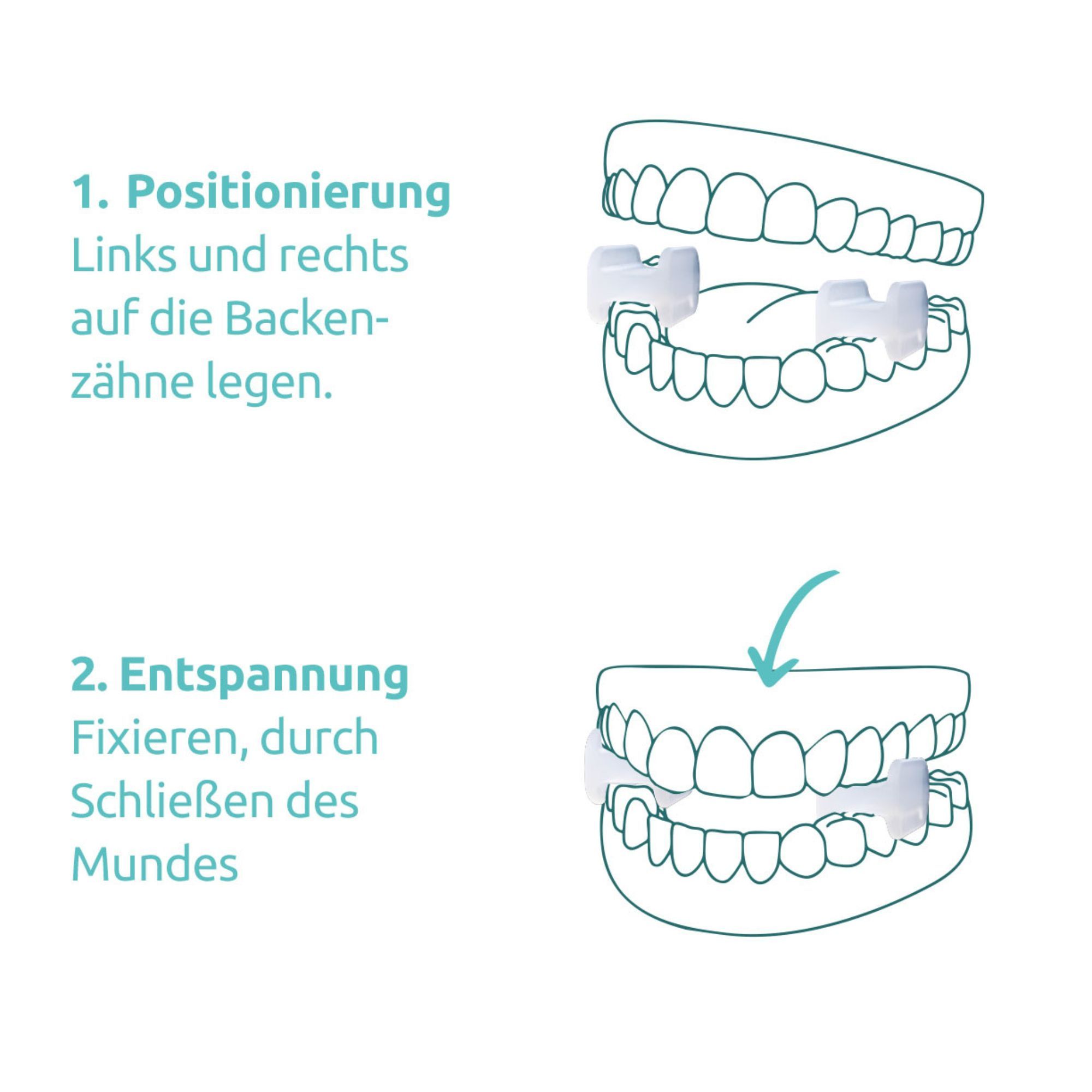 Illustration der Anwendung von TJ-Motion Aligner im Mund. Schritt 1: Positionierung. Schritt 2: Entspannung.