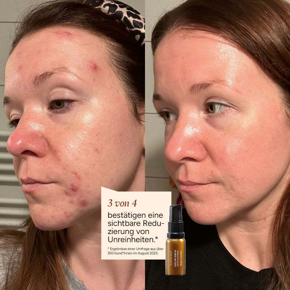 JUNGLÜCK KENNENLERN SET Unreinheiten mindern