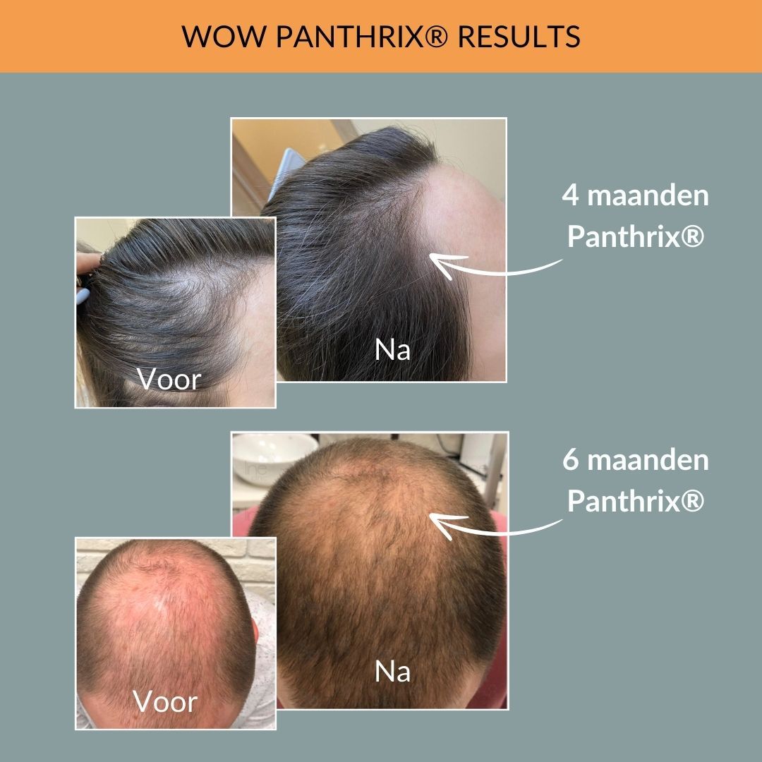 Voor- en na foto's van hoofdhuid. Tekst: 4 maanden met Panthrix, 6 maanden met Panthrix. Resultaten.
