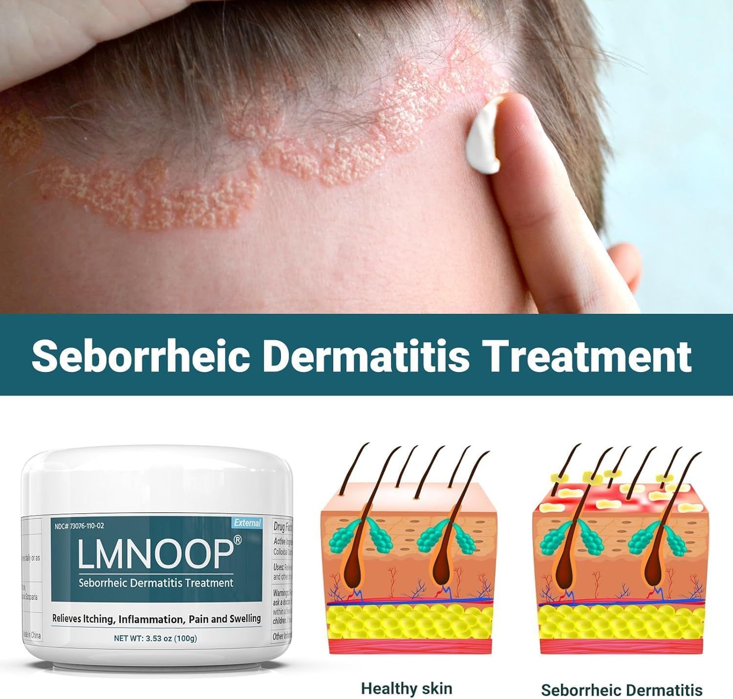 LMNOOP Seborrhoische Dermatitis Creme Extra Starke Kopfhautbehandlung