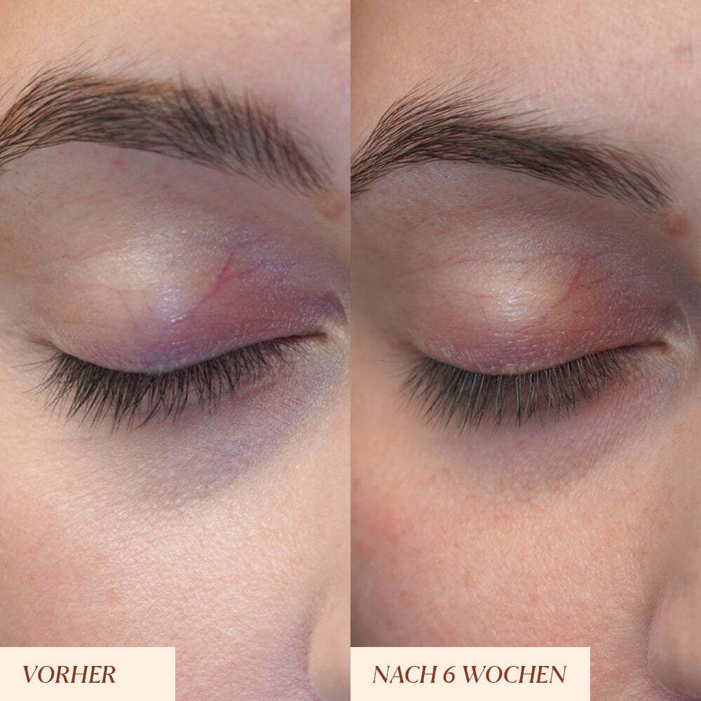 Augenpartie mit Wimpern. Vorher-Nachher-Vergleich. Text: Vorher, Nach 6 Wochen. Augenpartie mit Rötung.