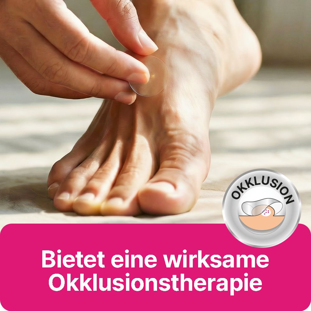 Fuß mit Warzenpflaster. Bietet eine wirksame Okklusionstherapie. Auf dem Pflaster ist ein kleiner, runder Bereich zu sehen.