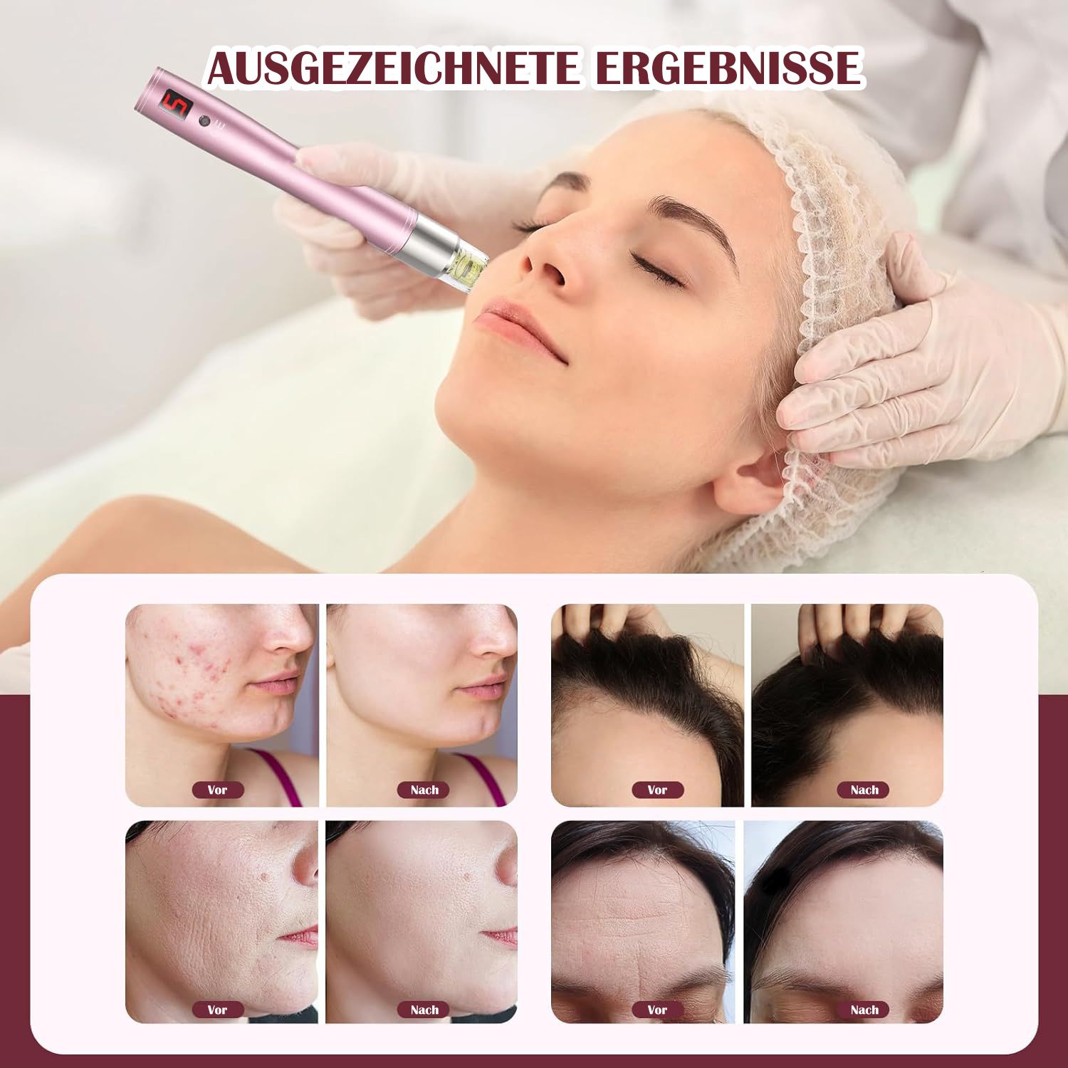COOL-i Microneedling Pen mit Serum Auftrag ,kabellos, 5 Stufen & Patronen für Hautpflege A3