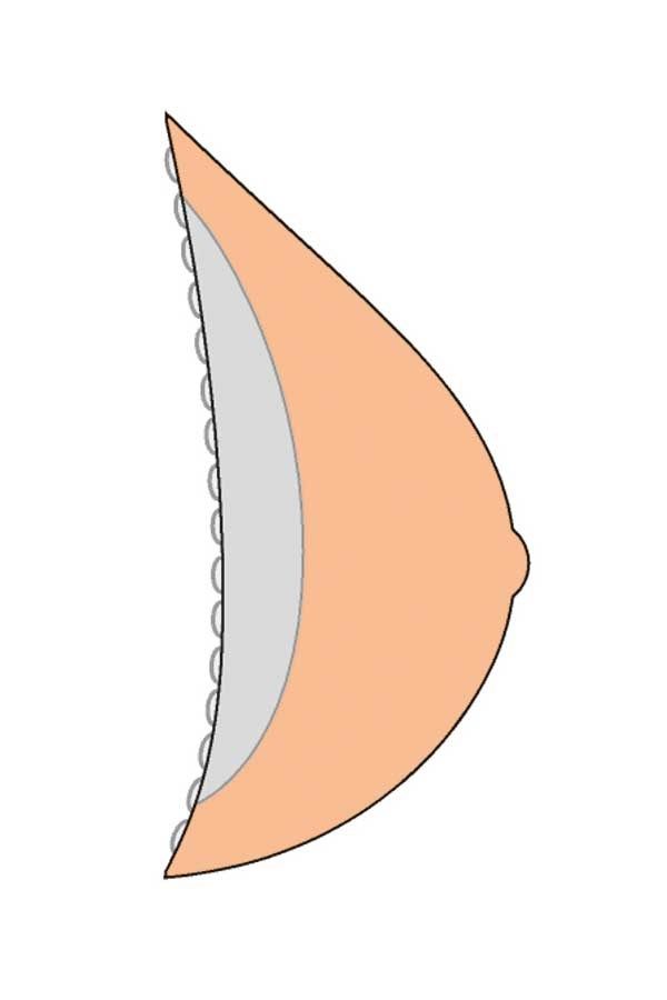 Schematische Darstellung einer Brustprothese. Geformt wie eine Brust, mit einer abgerundeten Form und einer leicht konkaven Seite.