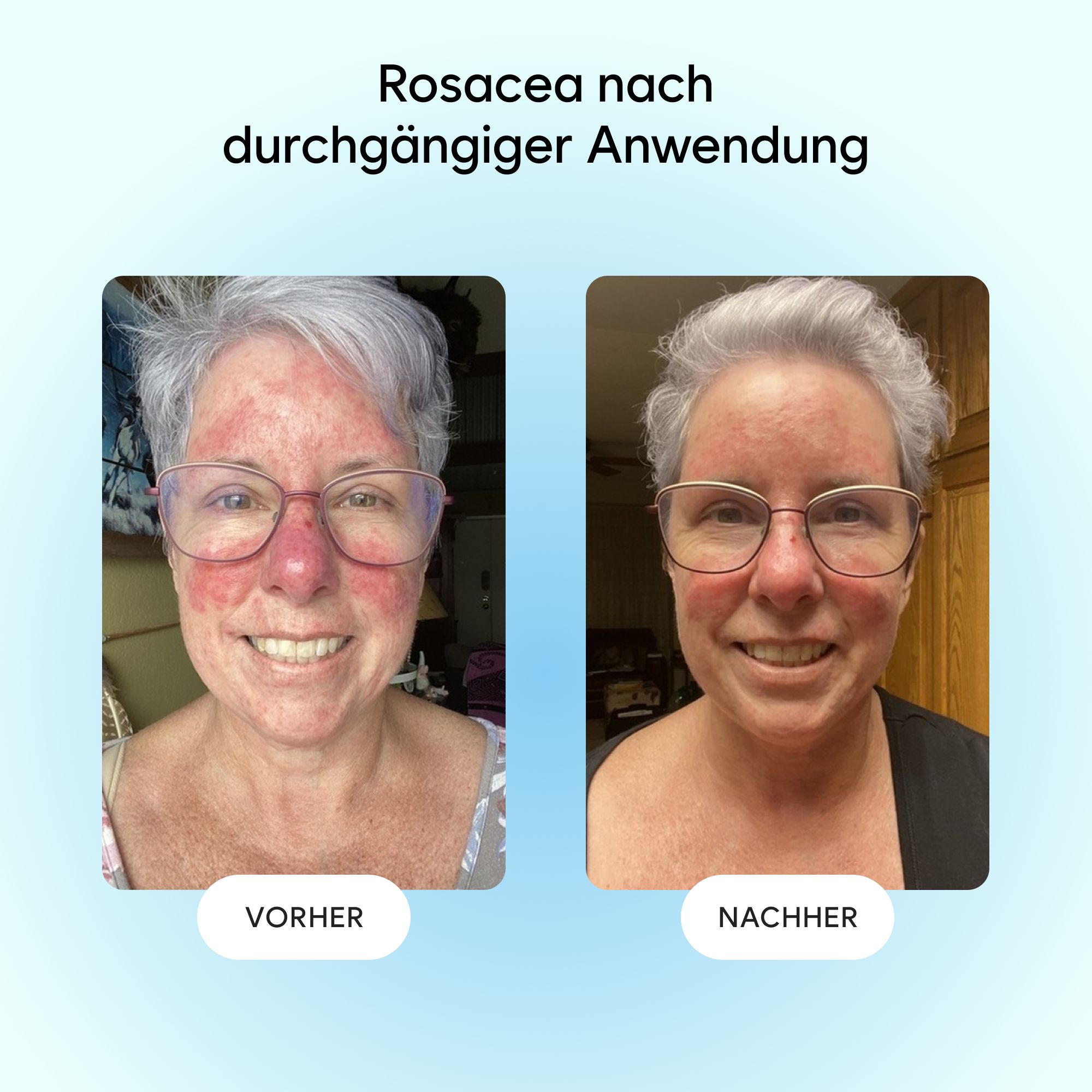 Gladskin Rosacear Gel