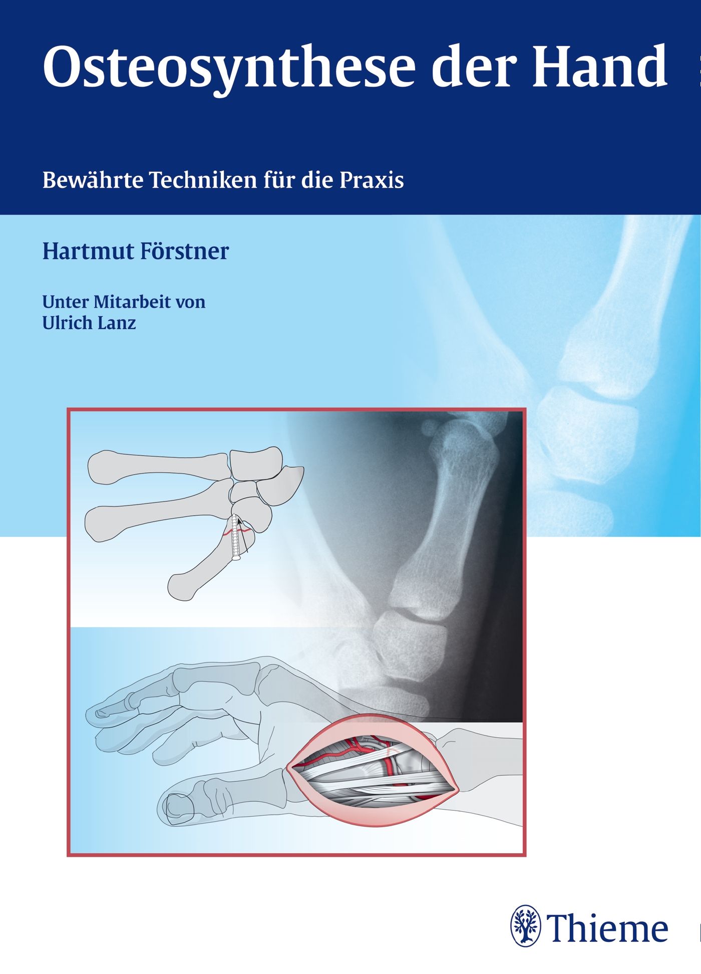 Buchcover mit Titel "Osteosynthese der Hand". Autor: Hartmut Förstner. Illustrationen von Handknochen und chirurgischen Eingriffen.