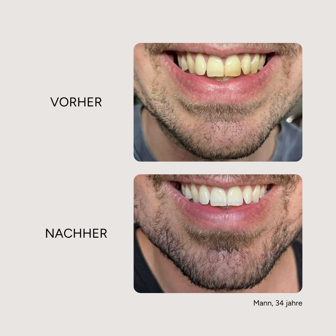Vorher-Nachher-Vergleich. Zähne vor und nach der Behandlung. Text: Vorher, Nachher. Mann, 34 Jahre.