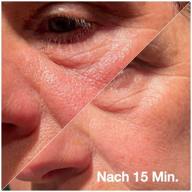 Gesicht, geteilt. Links: Haut vor Anwendung. Rechts: Haut nach 15 Minuten. Text: Nach 15 Min.