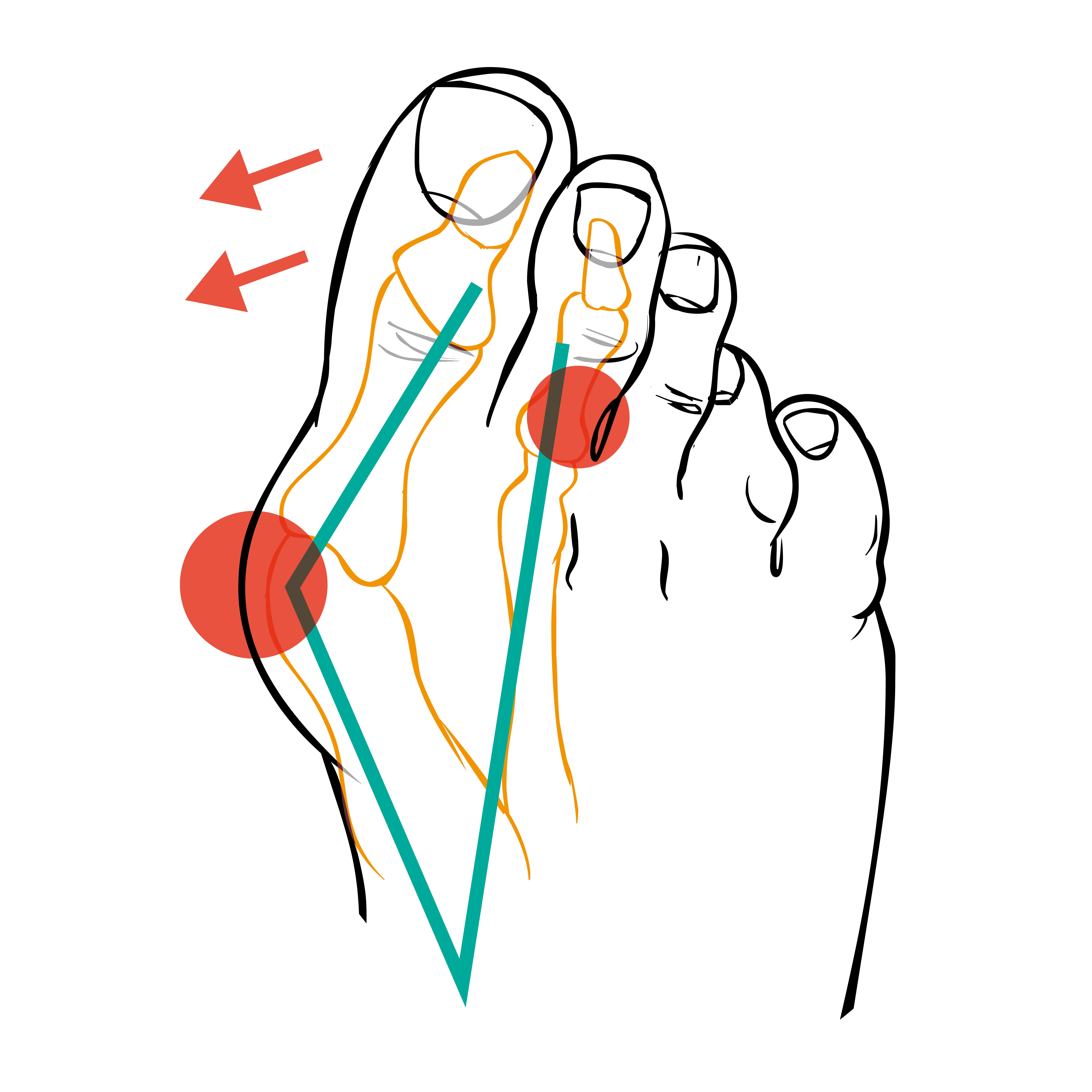Fuß-Illustration mit farbigen Markierungen und Pfeilen, die eine medizinische Darstellung des Hallux Valgus zeigen.