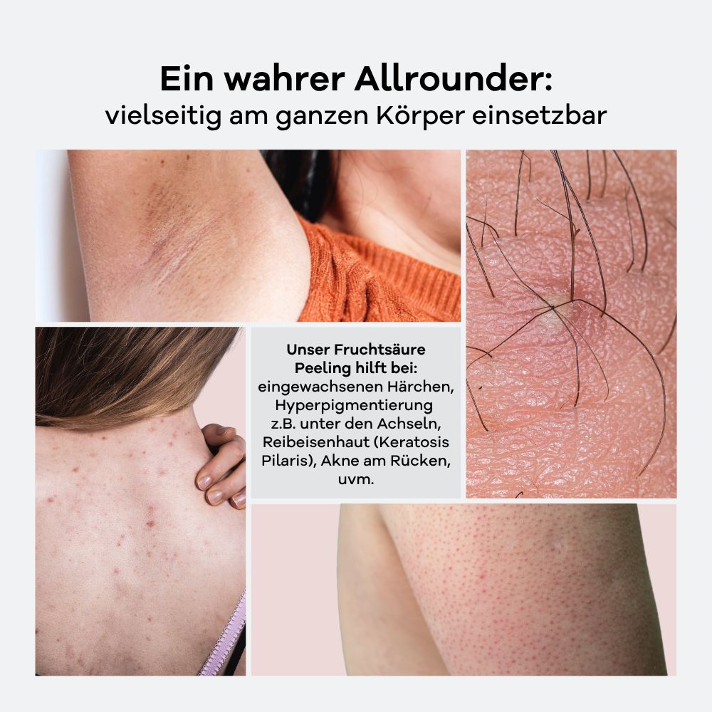 Collage zeigt Hautprobleme, bei denen das Fruchtsäure Peeling hilft: eingewachsene Haare, Akne.