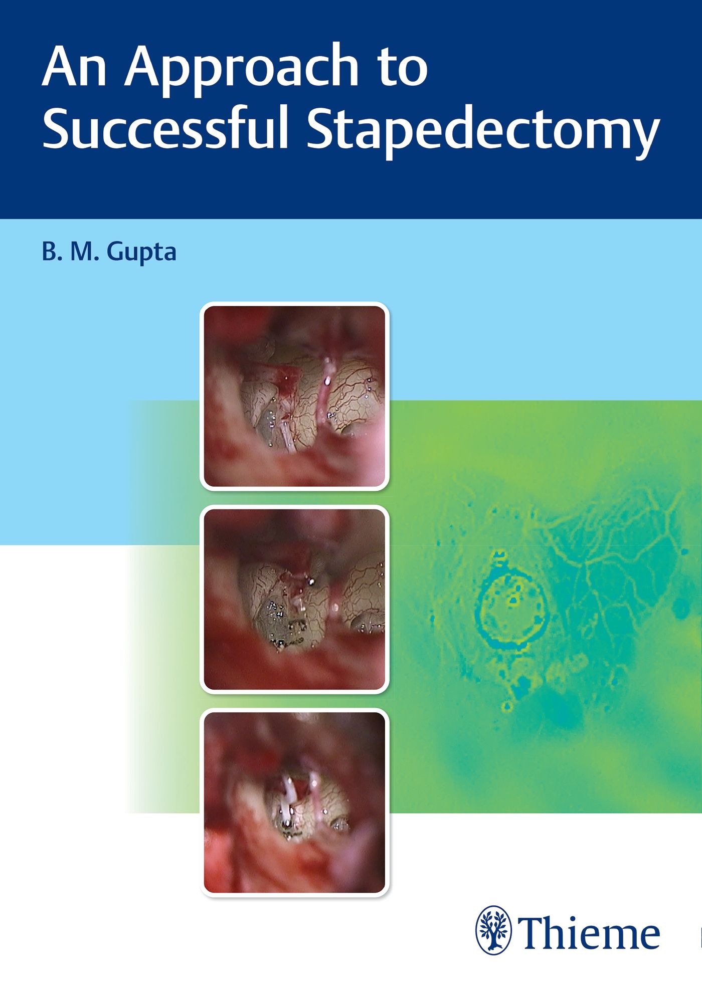 Buchcover: "An Approach to Successful Stapedectomy" von B. M. Gupta. Abbildungen von medizinischen Eingriffen. Thieme-Logo.
