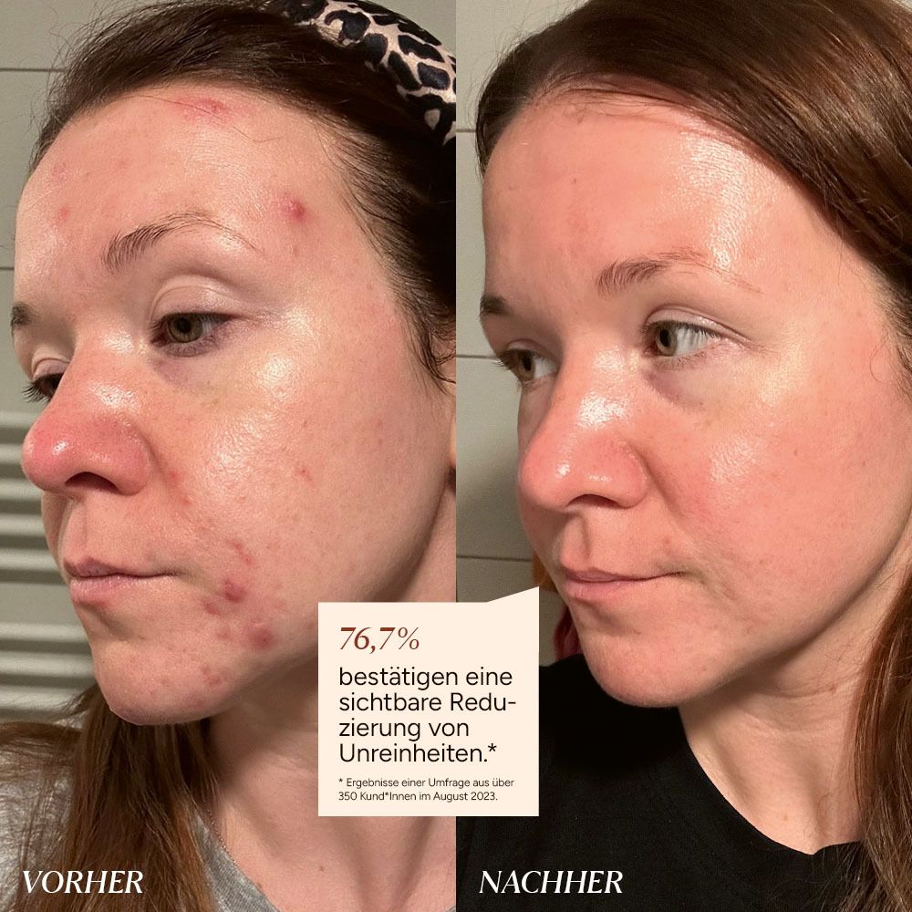 JUNGLÜCK Azelain Serum - gegen Pickel & Rötungen, 10% azelaic acid