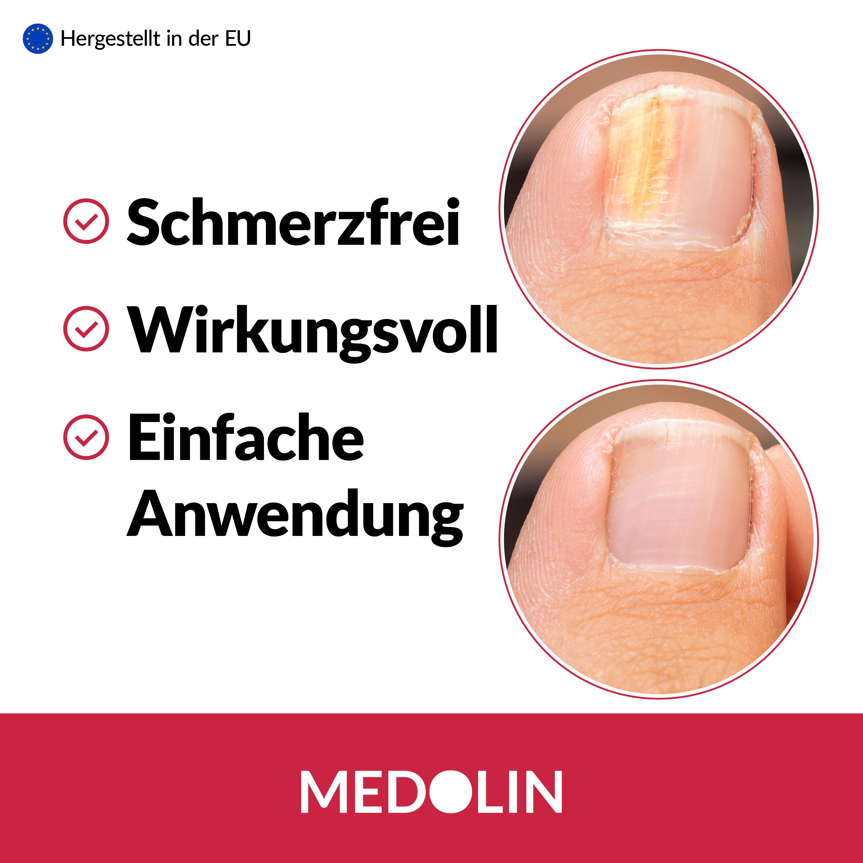 Medolin Nagelpilz Lösung 2er Set