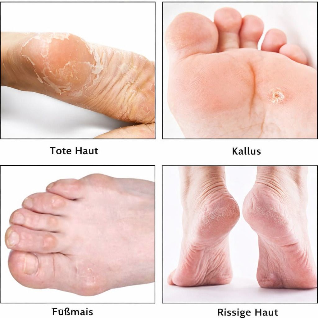 Hornhautfeile Set Edelstahl, Fußschaber & Feile mit 10 Klingen für Pediküre & Fußpflege