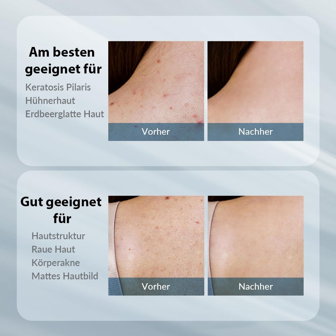 Vorher-Nachher-Vergleich. Geeignet für Keratosis Pilaris, Erdbeerhaut. Gut geeignet für Hautstruktur, raue Haut, Körperakne.