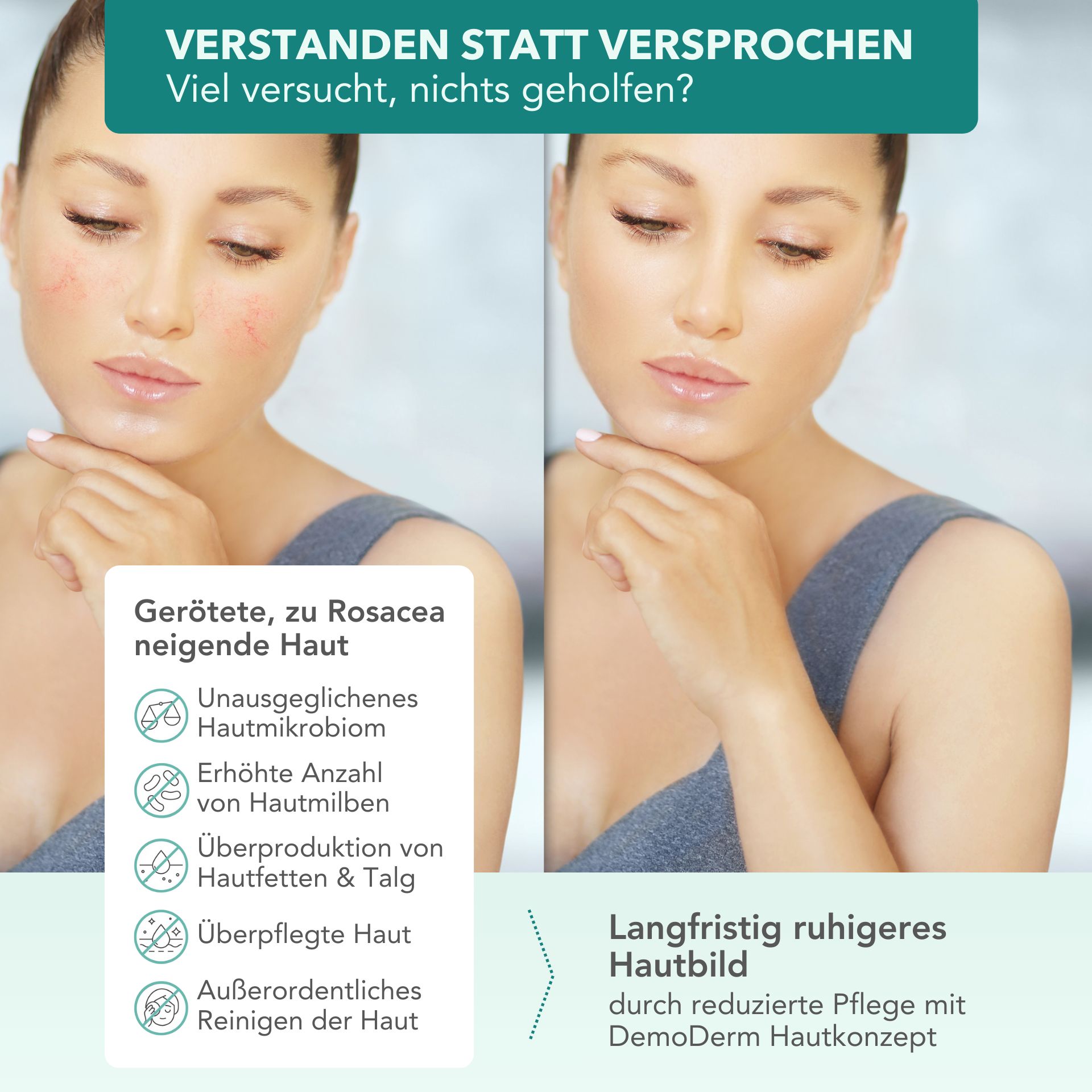 Vorher-Nachher-Vergleich. Gesicht mit Rosacea. Text: Gerötete, zu Rosacea neigende Haut. Langfristig ruhigeres Hautbild.