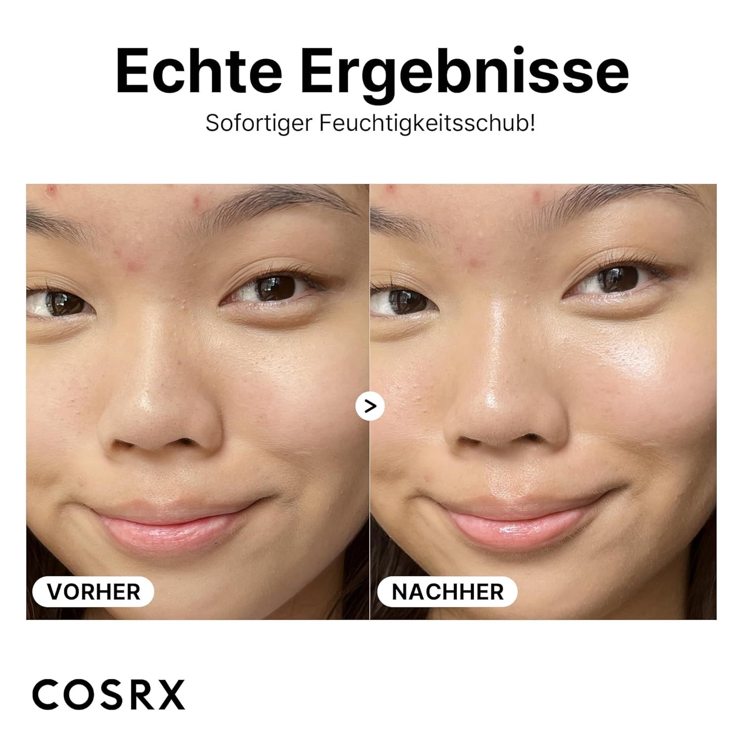 Vorher-Nachher-Vergleich von Gesichtern. Aufschrift: Echte Ergebnisse, COSRX. Deutliche Verbesserung des Hautbildes nach Anwendung.
