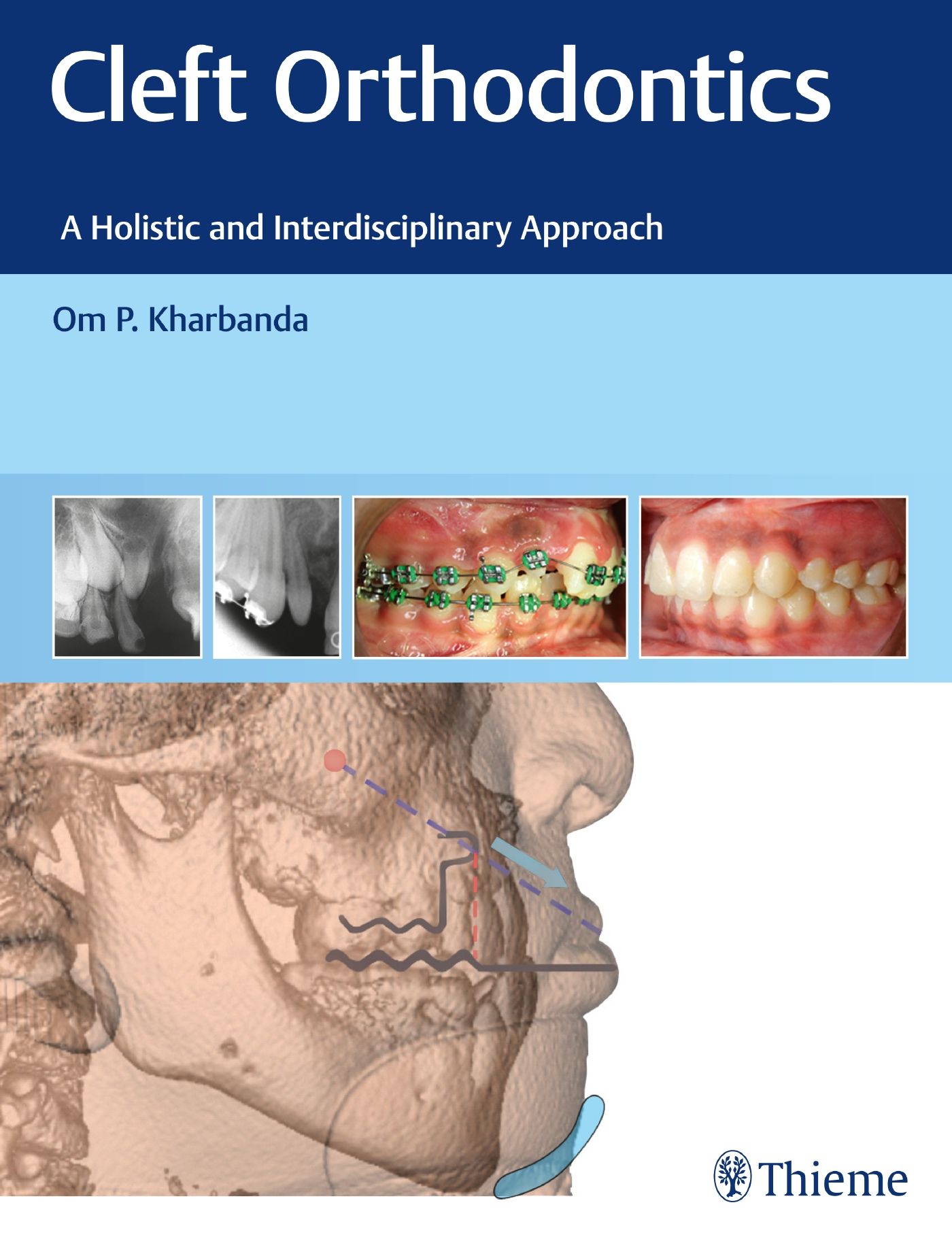 Buchcover: Cleft Orthodontics. Titel, Untertitel, Autor, Röntgenbilder, Zahnspange, Kiefermodell. Verlag Thieme.