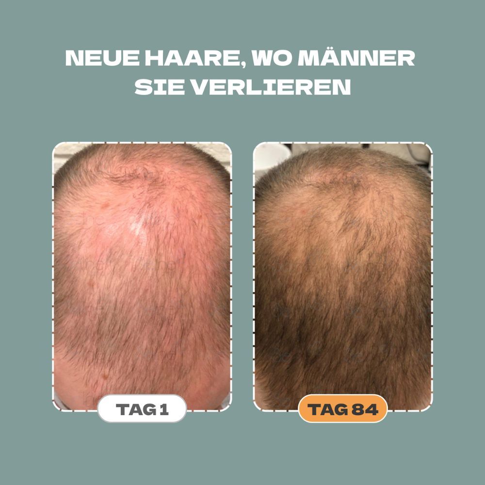 Panthrix Haarwuchs Aktivator Bundle