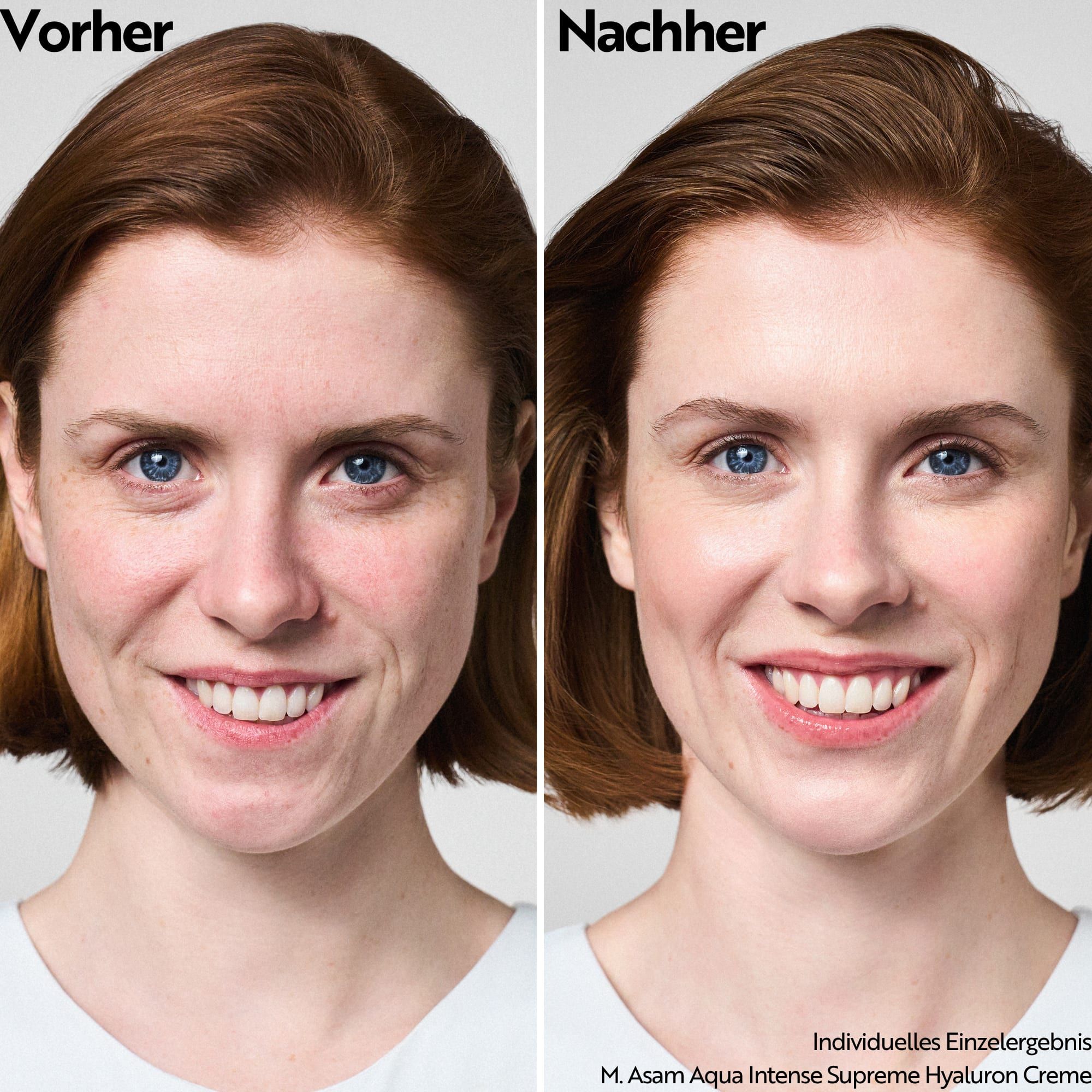 Vorher-Nachher-Vergleich einer Frau, die M. Asam Aqua Intense Supreme Hyaluron Creme verwendet.