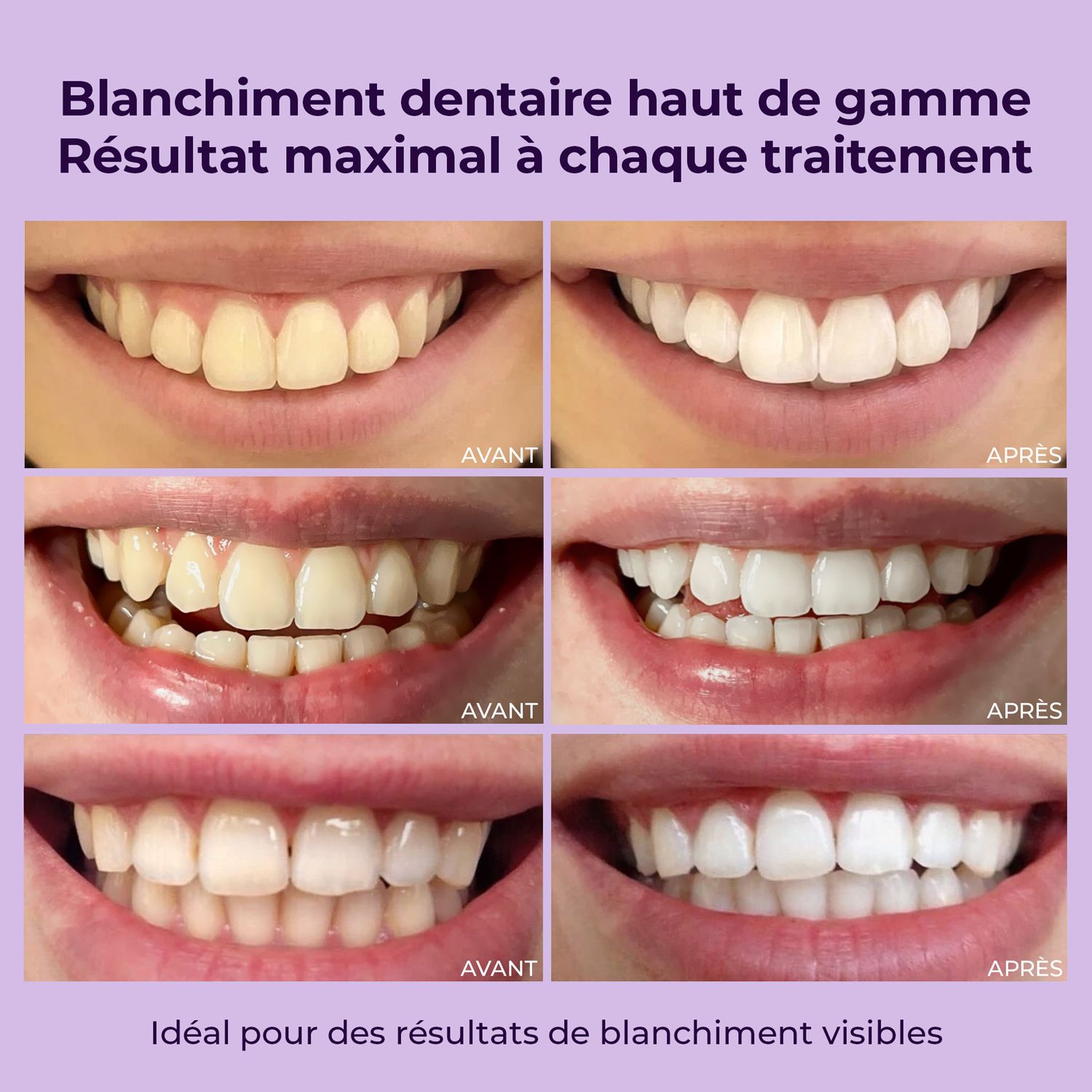 Comparaison avant-après de dents. Différents résultats de blanchiment dentaire sont montrés. Idéal pour des résultats visibles.