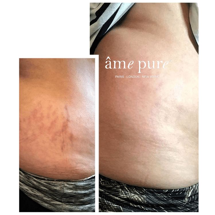âme pure Body Basic | Stretch Marks