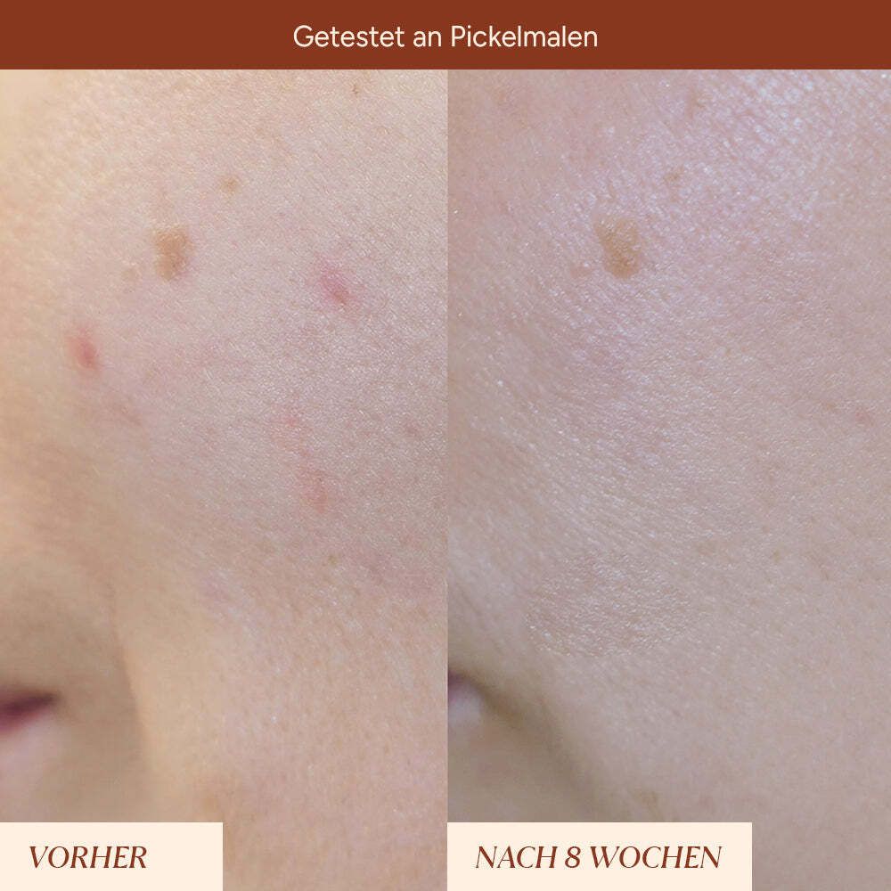 Vergleichsfoto: Hautpartie mit Pickelmalen (Vorher) und nach 8 Wochen (Nachher).