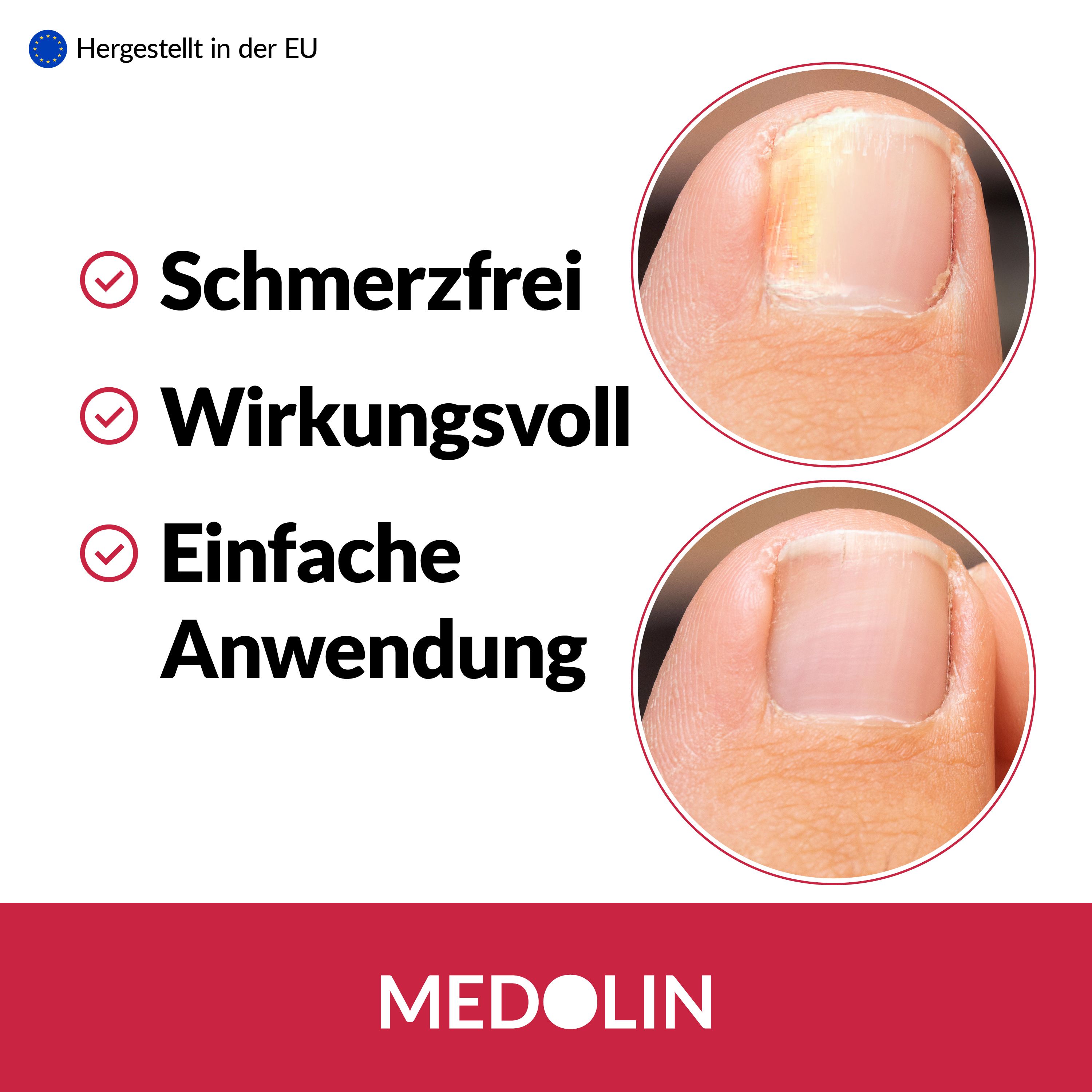 Medolin Nagelpilz Lösung 2er Set
