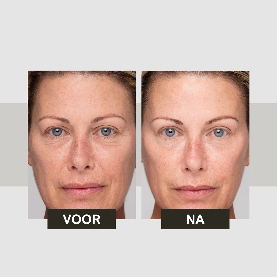 Voor-en-na vergelijking. Twee gezichten van een vrouw. Links: Voor. Rechts: Na.