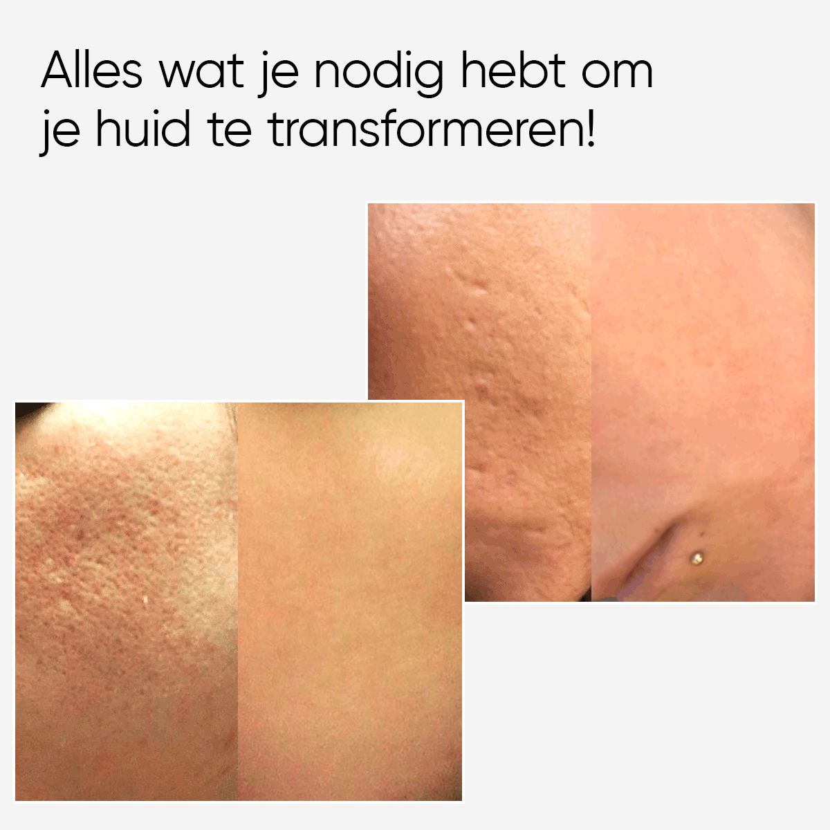 Voor- en nafoto's van huidonvolkomenheden. Tekst: Alles wat je nodig hebt om je huid te transformeren!