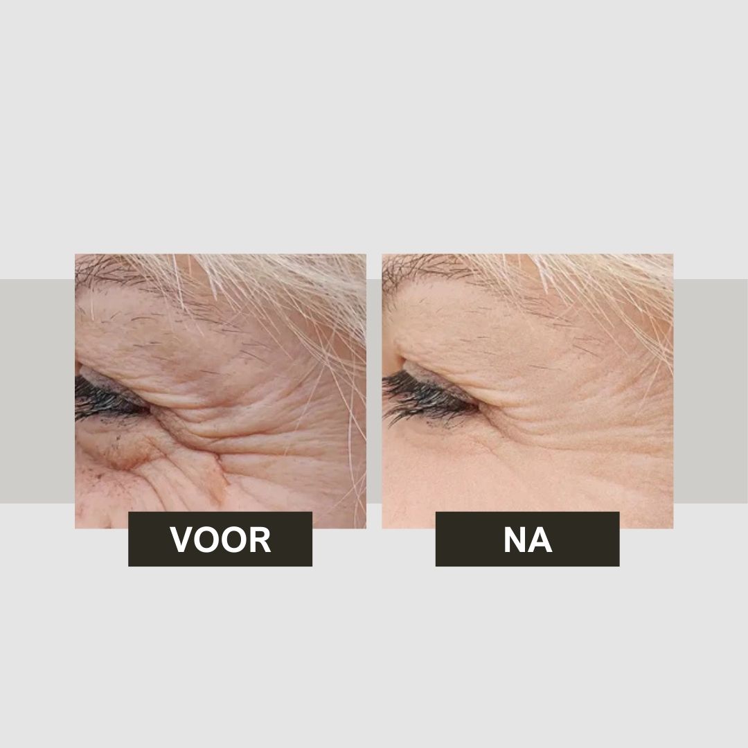 Voor-na vergelijking. Oogcontour met rimpels. Tekst: Voor, Na.