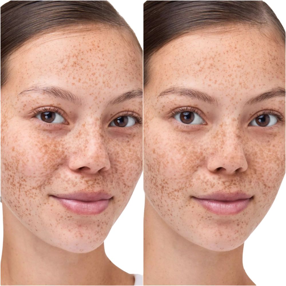 Zwei Nahaufnahmen eines Gesichts. Links: Gesicht mit Sommersprossen. Rechts: Gesicht mit Sommersprossen, Haut wirkt ebenmäßiger.