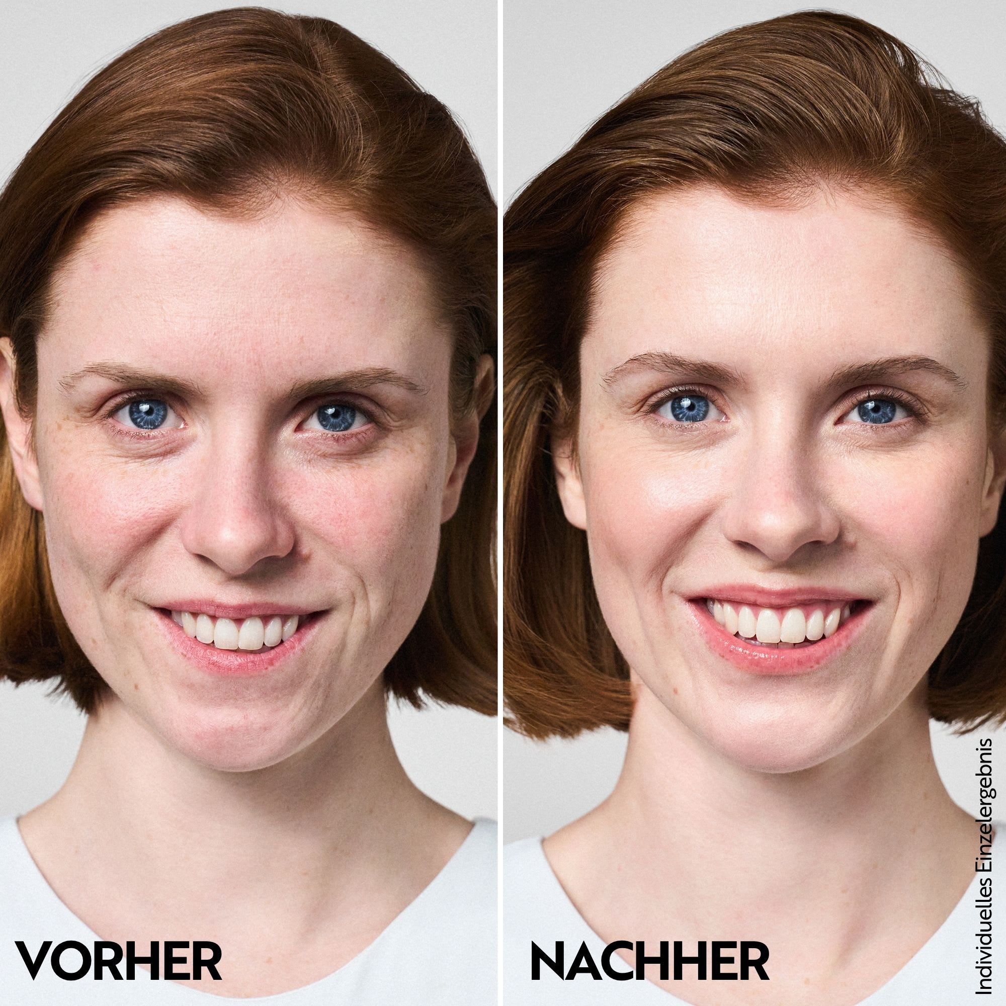 Vorher-Nachher-Vergleich einer Frau, die M. Asam AQUA INTENSE Hyaluron Augencreme verwendet.