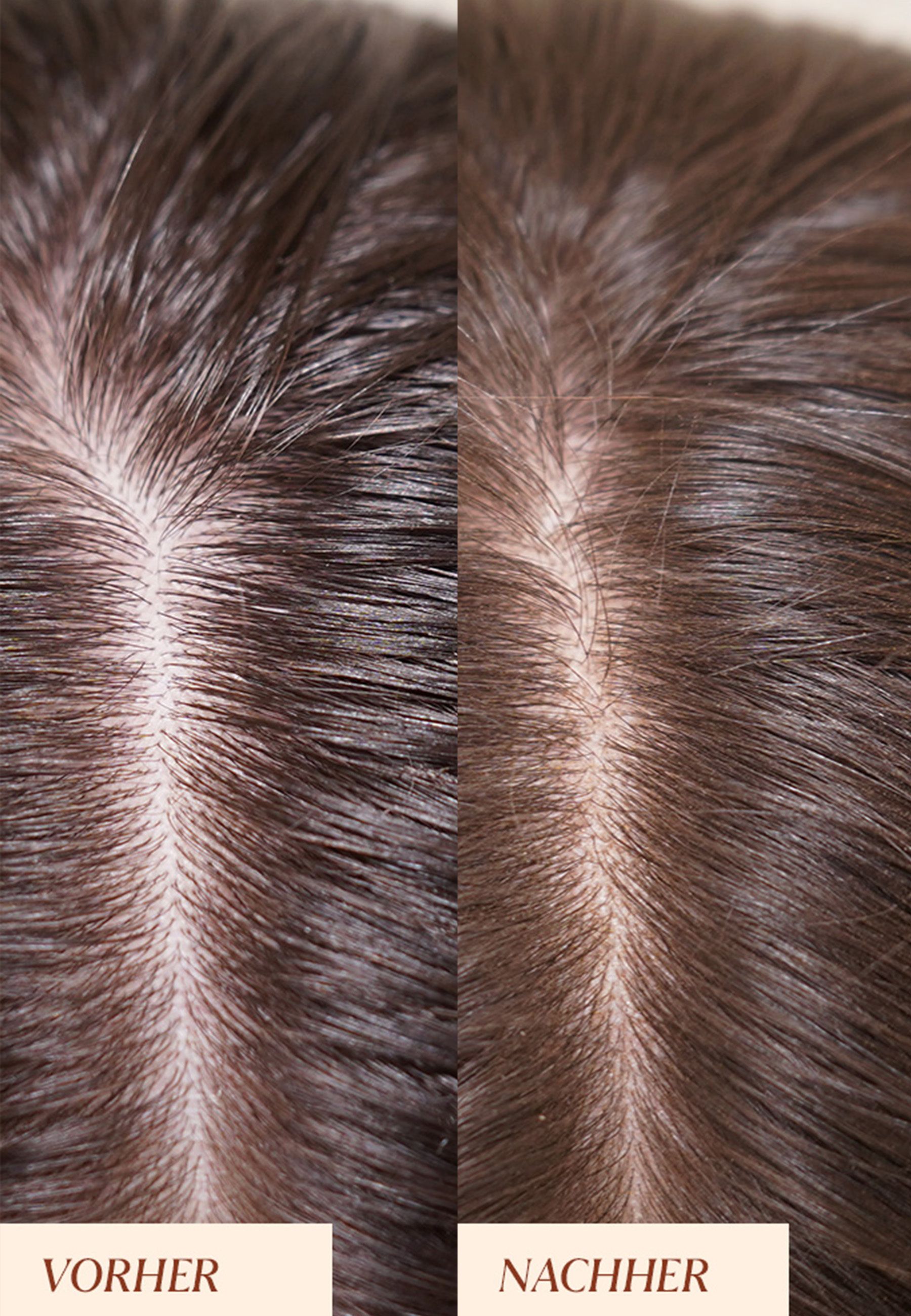 Haaransatz, Vorher-Nachher-Vergleich. Links: heller Ansatz. Rechts: dunkler Ansatz.