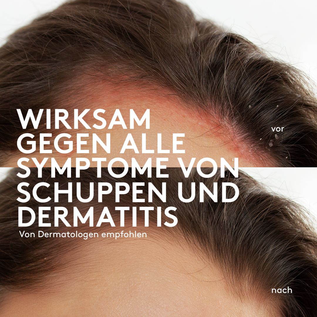 Sphagnum Botanicals DermAid Shampoo – bei seborrhoischem Ekzem & Psoriasis