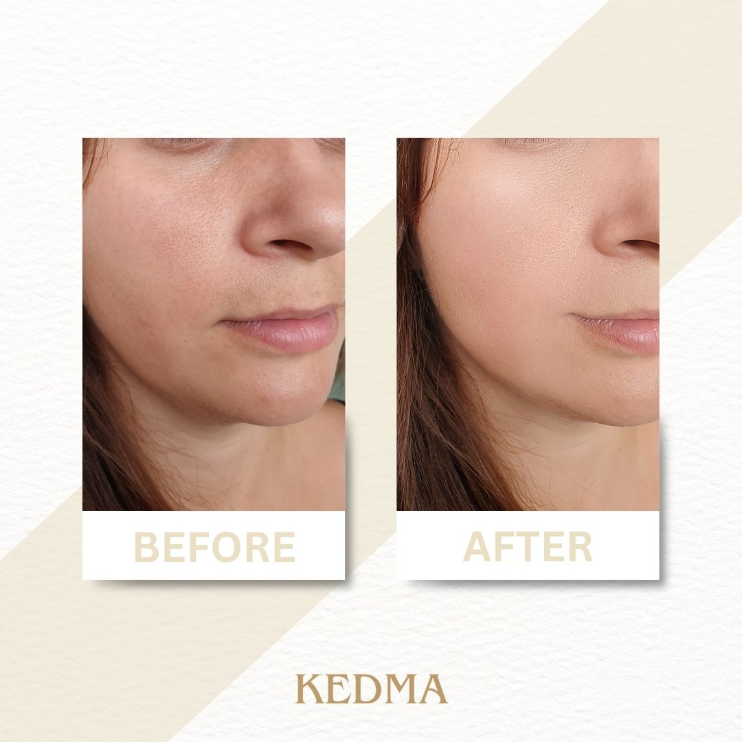Comparaison avant-après. Peau du visage. Logo Kedma.