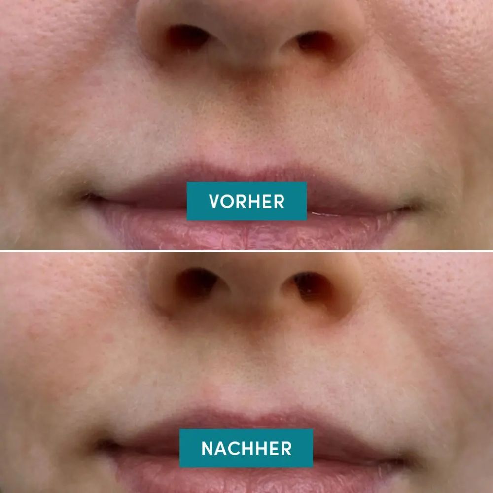 Vorher-Nachher-Vergleich. Obere Reihe: Mund mit Falten. Untere Reihe: Mund ohne Falten. Text: Vorher, Nachher.